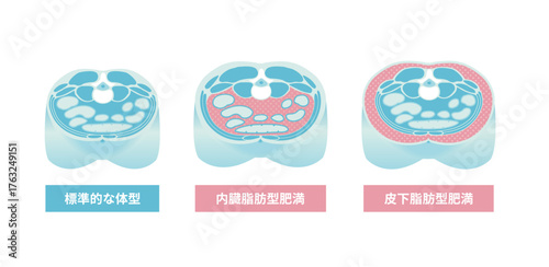 腹部断面図イラスト「肥満のタイプ」/ 内臓脂肪・皮下脂肪
