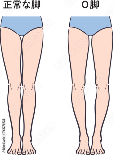 正常な脚とO脚のセット