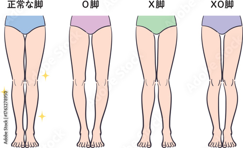 正常な脚とX脚・O脚・XO脚のセット