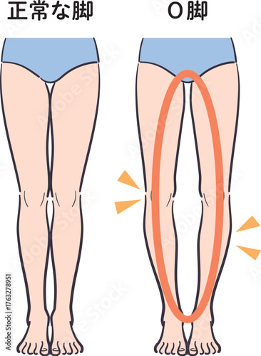 正常な脚とO脚の比較イラスト（補助線あり）