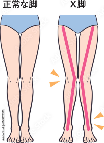 正常な脚とX脚の比較イラスト（補助線あり）