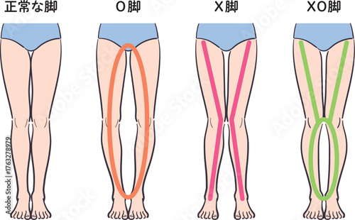 正常な脚とX脚・O脚・XO脚の比較イラスト
（補助線あり）