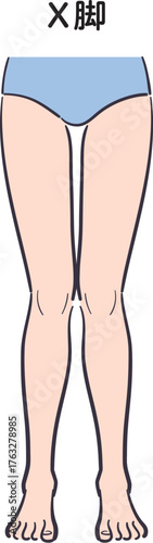 若い女性の脚（X脚）