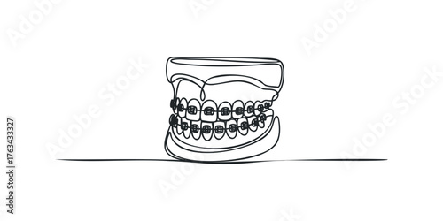 Teeth braces on a dental model
