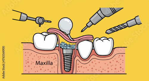 Detailed dental implant diagram showing maxilla bone preparation for successful tooth replacement. Illustration depicts bone grafting, sinus lift procedure, utilizing specialized dental instruments.