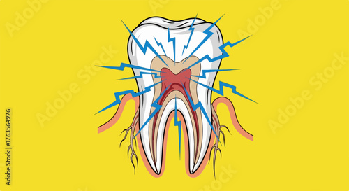 Detailed illustration of tooth pain showing white molar with internal anatomy, inflamed red pulp, and nerve endings. Acute tooth pain radiates with blue lightning flashes around roots,