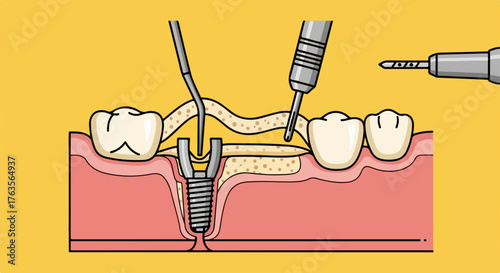 Detailed dental implant placement diagram, showing bone graft. Surgical dental implant process includes instruments, drill, bone regeneration.