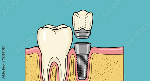 Dental implant procedure shows screw implant with crown placement, showing healthy tooth alongside. Dental implant diagram illustrates treatment of tooth loss for restored smile, enhanced confidence.