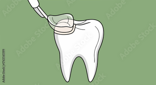 Illustration of a dental filling procedure on a single molar. Dental tool carefully applies restorative material to tooth surface, explaining stages of a dental filling.