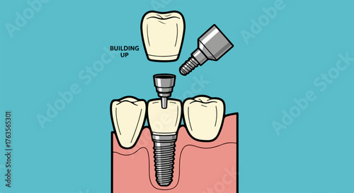 Dental implant illustration showing tooth replacement process, from screw insertion to crown placement. Abutment and artificial tooth visible.