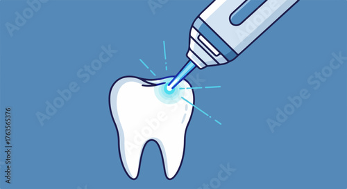 Dental laser treatment illustration of tooth with laser beam in a dental office. Modern dental laser treatment in dentistry for dental hygiene to make teeth whiter and healthy.