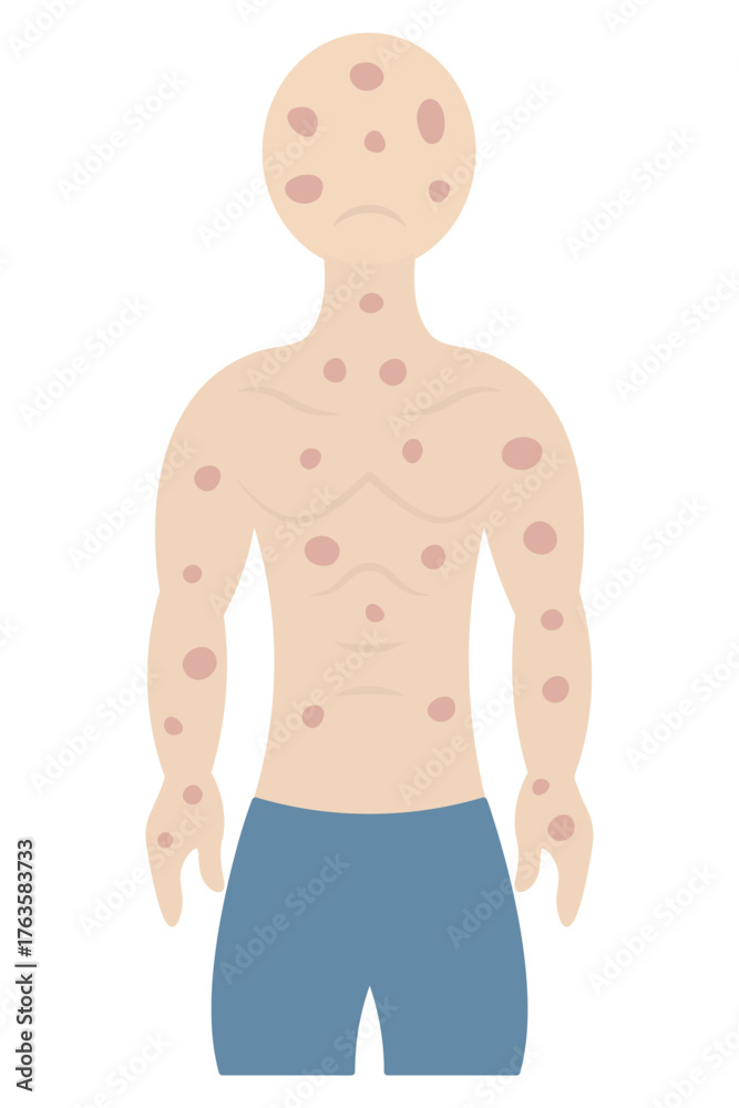 Fototapeta premium Rash on a human body. The patient's face and body are covered with pink spots. The muscular man is sad. Color vector illustration. Isolated on white background. Flat style. Medical theme. 