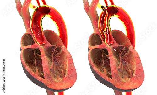 Normal aorta compared with aortic dissection, 3D illustration