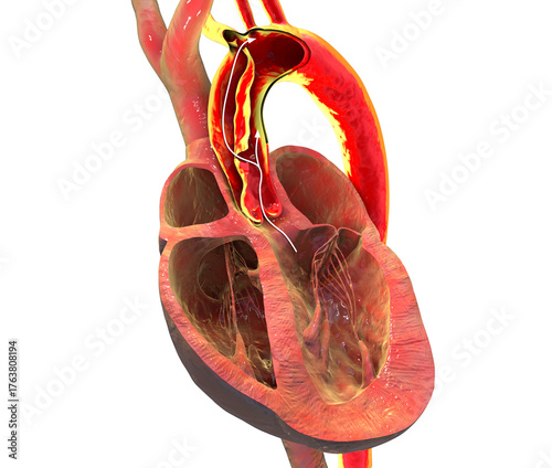 Ascending aortic dissection, 3D illustration