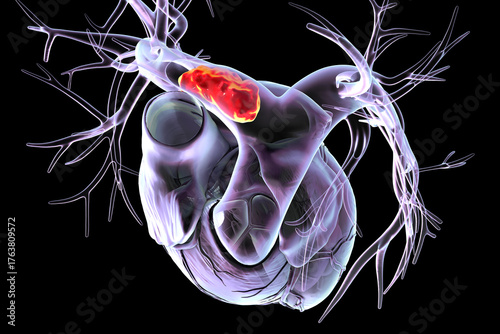Right pulmonary embolism, 3D illustration.