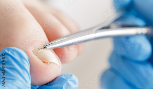 Canvas Print Macro Podiatrist treating ingrown toenail with precision instruments