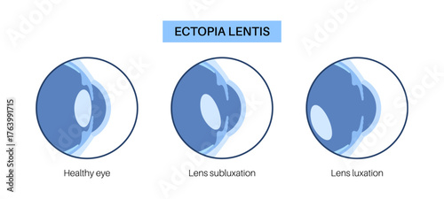 Ectopia lentis disease