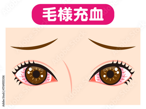 	毛様充血で充血した両目のイラスト素材
