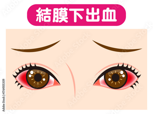 	結膜下出血で充血した両目のイラスト素材