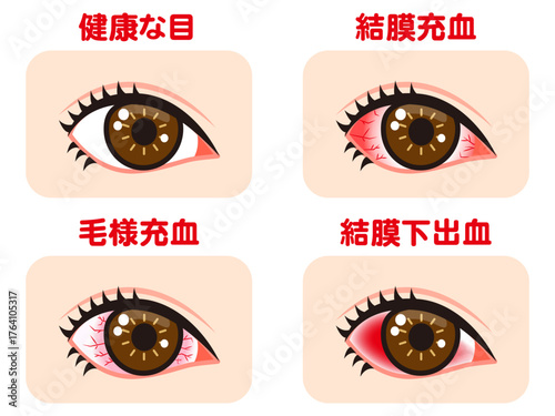 充血する片目の図解イラスト素材セット