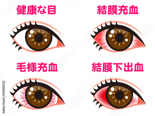 充血する片目の図解イラスト素材セット2