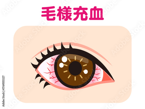 	毛様充血で充血した片目のイラスト素材