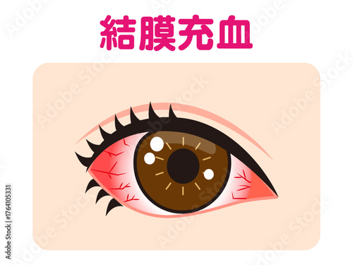 	結膜充血で充血した片目のイラスト素材