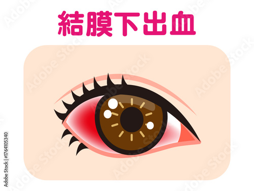 	結膜下出血で充血した片目のイラスト素材