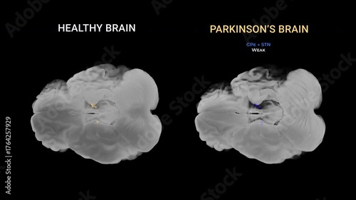 Parkinson’s Disease Brain Comparison Axial View Dopaminergic Dysfunction
