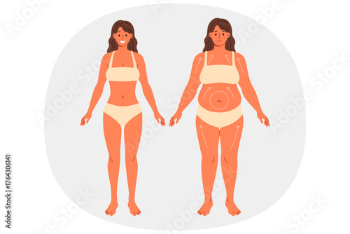 Liposuction for overweight woman posing in underwear before and after surgery. Beautiful girl in need of liposuction demonstrates progress achieved without use of diets and fitness