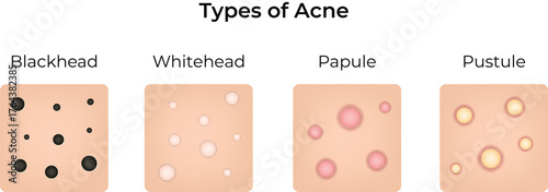 Visual Guide to Common Acne Types Vector Illustration