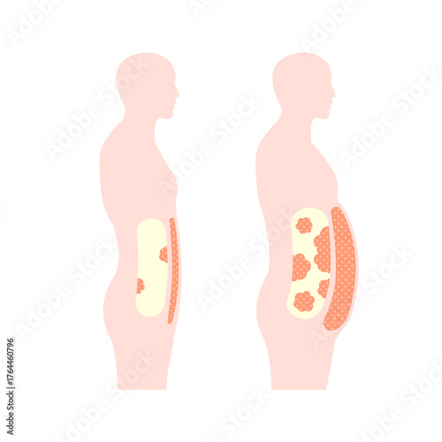 Human silhouette illustration of visceral fat and subcutaneous fat