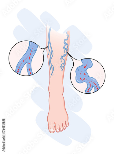 Varicose veins. Blue blood vessel visible through the skin, abnormally swollen leg. Vascular disease diagnostic and treatment. Venous insufficiency medical disease