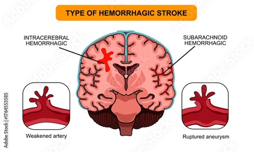 Brain stroke, hemorrhagic Intracerebral and subarachnoid. Arteriosclerosis, infarct, ischemia, thrombosis disease. Cholesterol in human blood vessels. Medical poster vector illustration.
