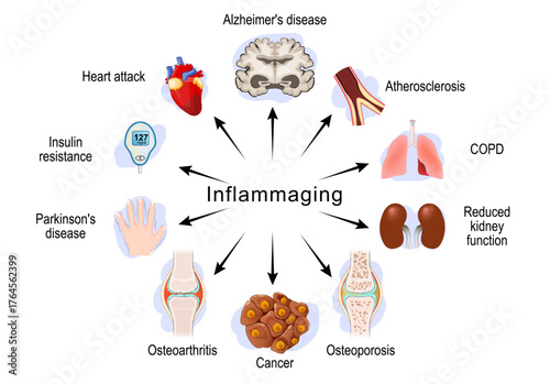 Inflammaging. Chronic sterile low-grade inflammation. Aging process. inflammation that develops with advanced age. Vector illustration