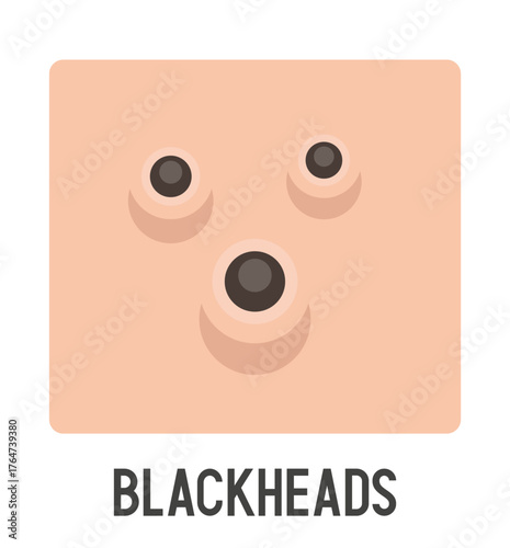 Blackheads vector illustration. Acne type. Vector flat illustration