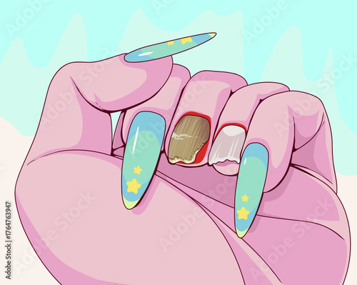 Nail plate disease. Nail plate fungus. Healthcare illustration.Vector illustration.