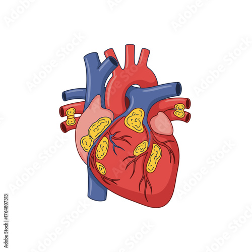 Illustrative human heart anatomy showing coronary arteries and chambers with visible blockages for medical education