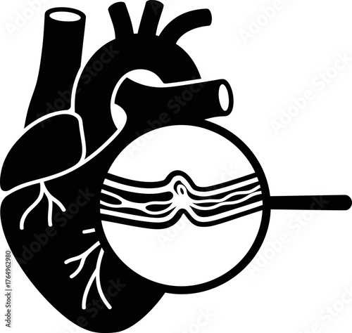 Heart Artery Blockage Diagram