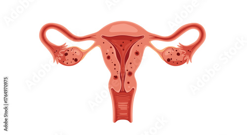 Illustration of Female Reproductive System with Endometriosis.