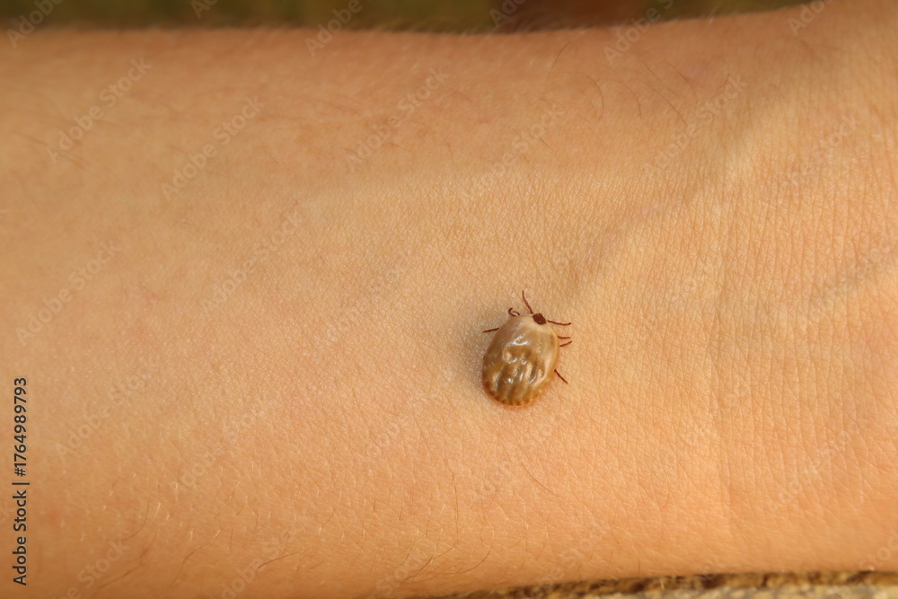 Obraz premium A blood-engorged female tick feeding directly from a visible human vein on the hand, showcasing parasite behavior and bloodsucking process in close-up biological detail.