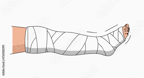 Leg in cast wrapped with white bandages displayed on plain background. Injured foot shown with toes exposed and immobilized in cast, emphasizing recovery process.