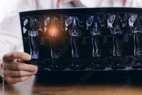Fotografia Closeup hand of doctor neurosurgeon analysis mri scan of spinal column showing disc protrusion of patient