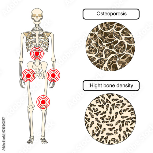 Illustration of osteoporosis, low bone density, spinal compression fracture, risk of fracture. back pain, hip bone. Vector for medical, clinical, or educational posters.