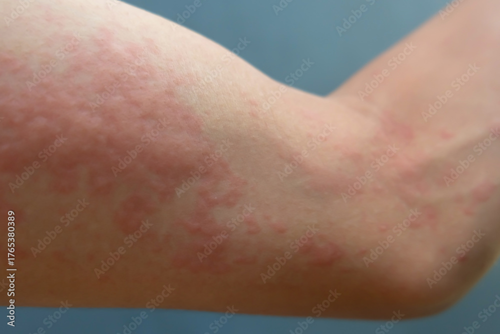 Naklejka premium Close-Up of Human Hand with Skin Allergy (Urticaria Rash)