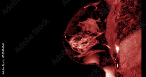 MRI of the breast footage demonstrating a round hypoechoic lesion in the right breast. Advanced radiology imaging for tumor detection and diagnostic evaluation. Low suspicion for malignancy.