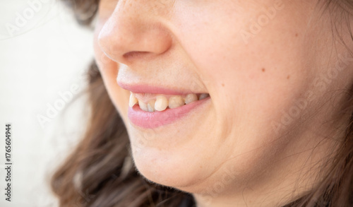 Quadro em tela Closeup of young woman smiling with crooked teeth, natural smile, happy expressi