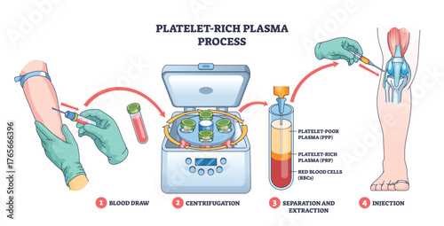 Platelet-rich plasma process shows blood draw, centrifuge separation, and PRP injection into the knee for healing, key objects, syringe, centrifuge, knee joint. Outline diagram