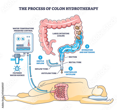 Colon hydrotherapy process diagram shows gentle inflow, hydration, and controlled outflow, key objects, colon, rectal tube, water control unit. Outline diagram