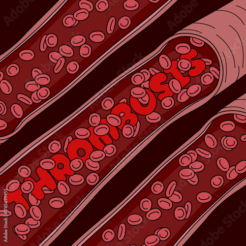This visual illustration depicts thrombosis, a serious medical condition characterized by the formation of blood clots in the veins. Perfect for celebrating World Thrombosis Day on October 13th.